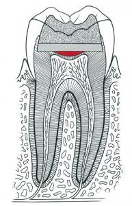 Traditional filling used to treat tooth decay