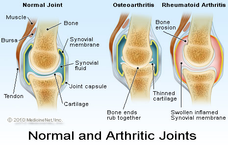 Rheumatoid Arthritis Dental Treatment